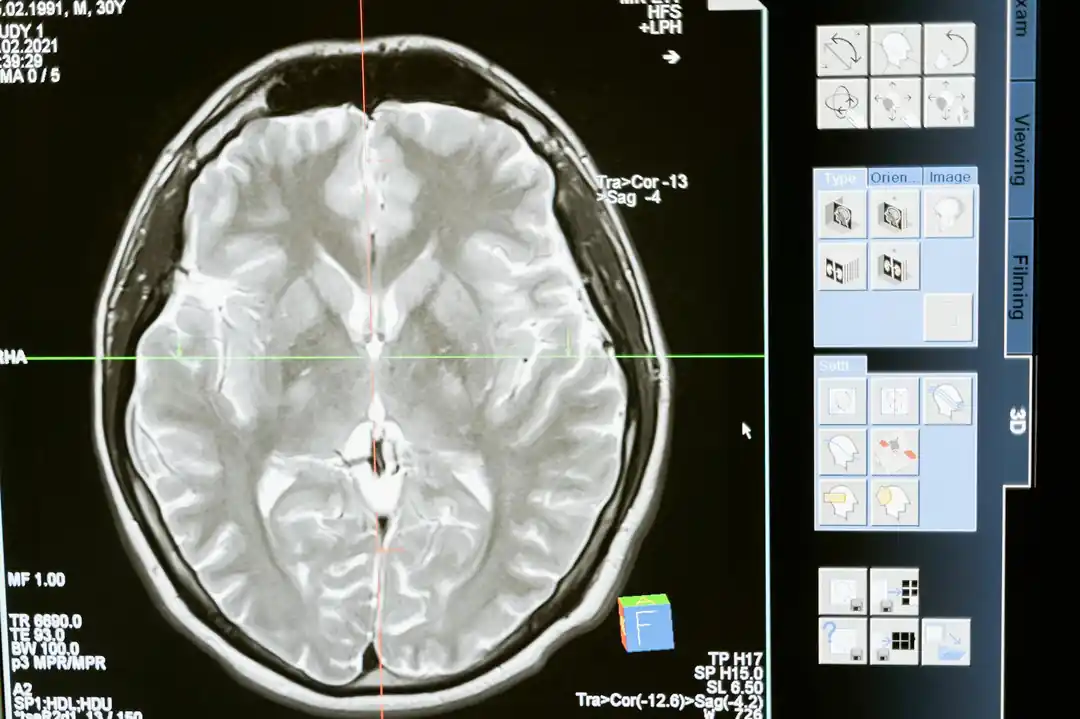 의료진이 컴퓨터 화면에 뜬 뇌 MRI 스캔 이미지를 분석하고 있다.