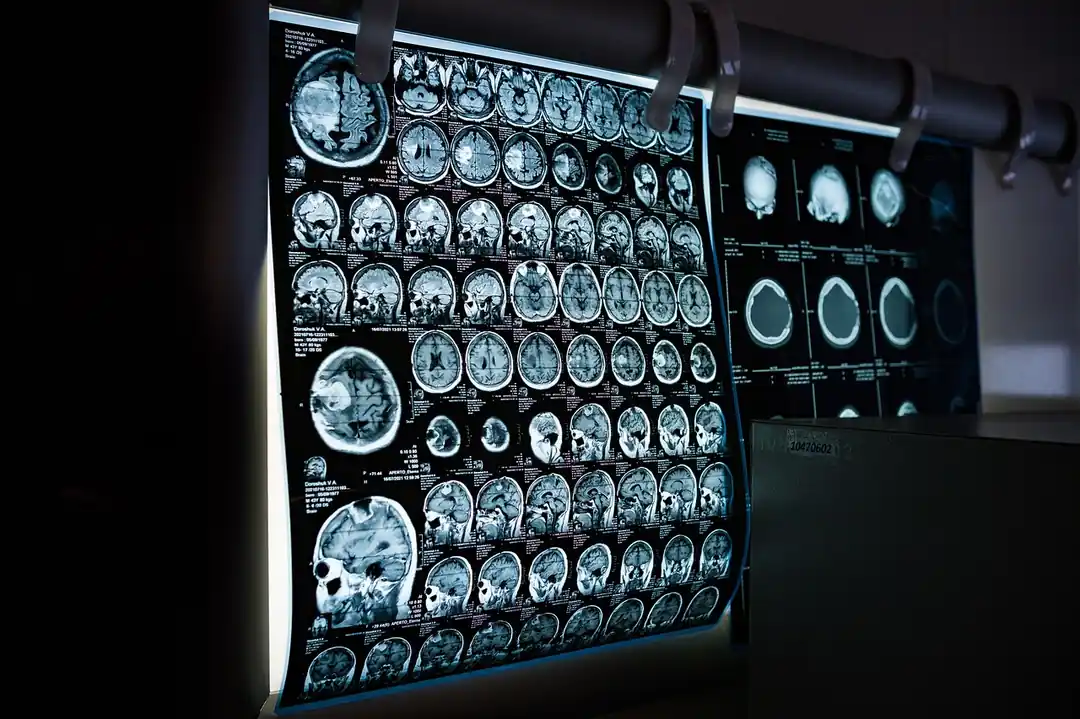 여러 장의 뇌 MRI 영상이 나란히 놓여 있는 모습